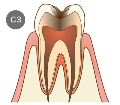 虫歯の画像3